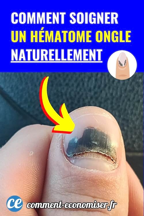 Gros plan sur un ongle avec un hématome noir sous la surface.