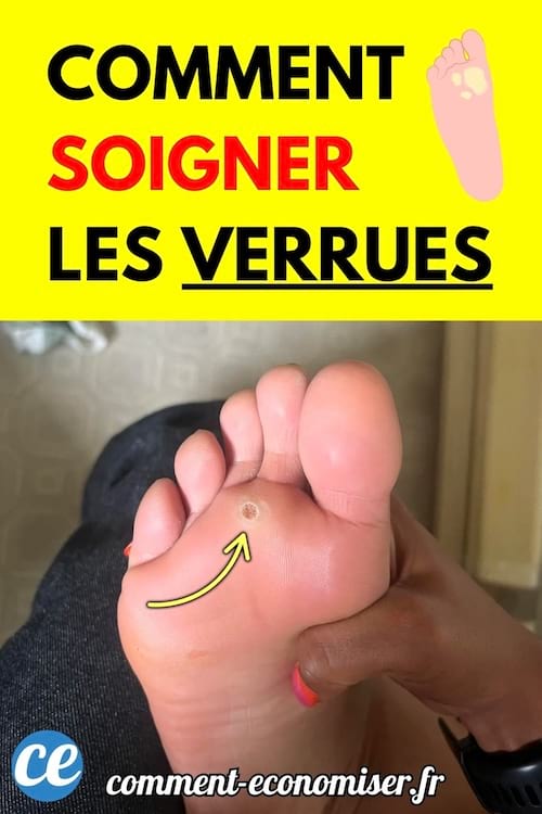 Pied avec verrue plantaire mise en évidence par une flèche jaune.
