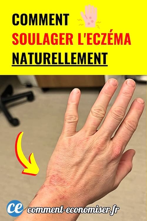 Main irritée montrant une plaque d’eczéma sur fond jaune avec flèche rouge.