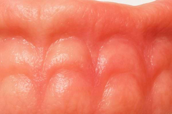 Gros plan sur une gencive rouge et legerement enflee.