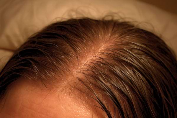 gros plan sur le dessus du crane montrant une raie large et un cuir chevelu apparent