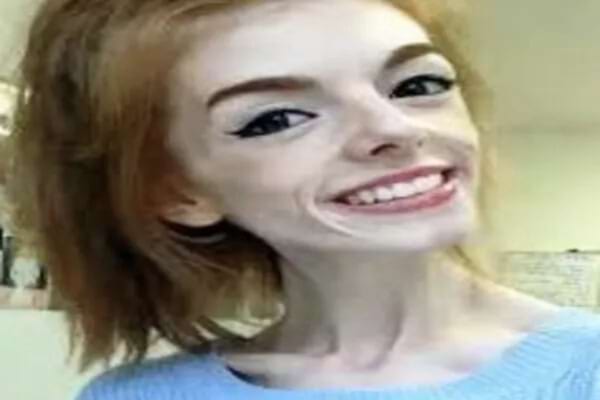 Une femme anorexique