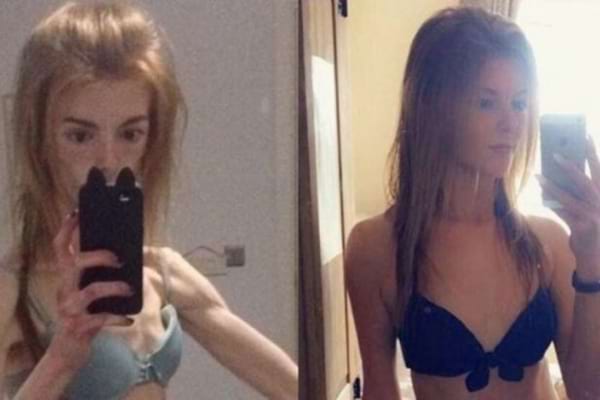 Une femme anorexique à gauche et la meme femme ayant pris du poids à droite
