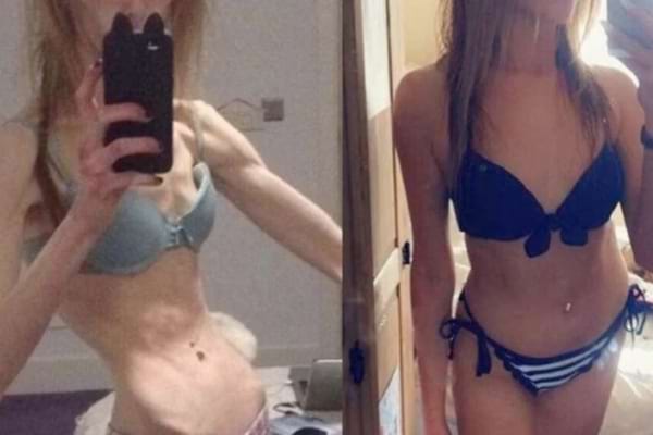 Une femme anorexique à gauche et la meme femme ayant pris du poids à droite