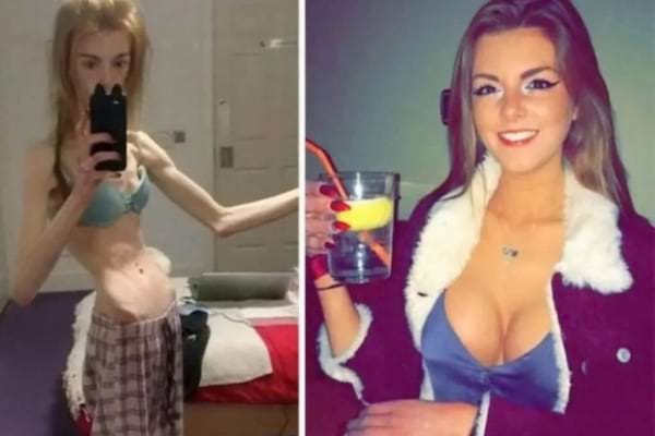 Une femme anorexique à gauche et la meme femme ayant pris du poids à droite