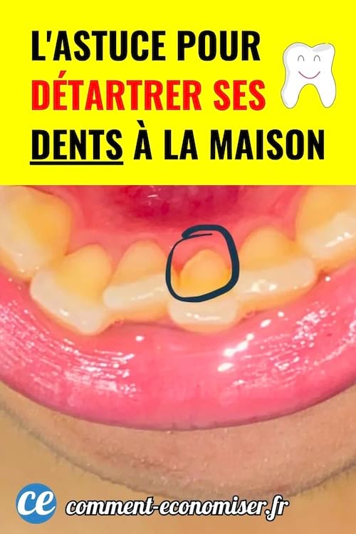 astuce simple pour detartrer ses dents a la maison.