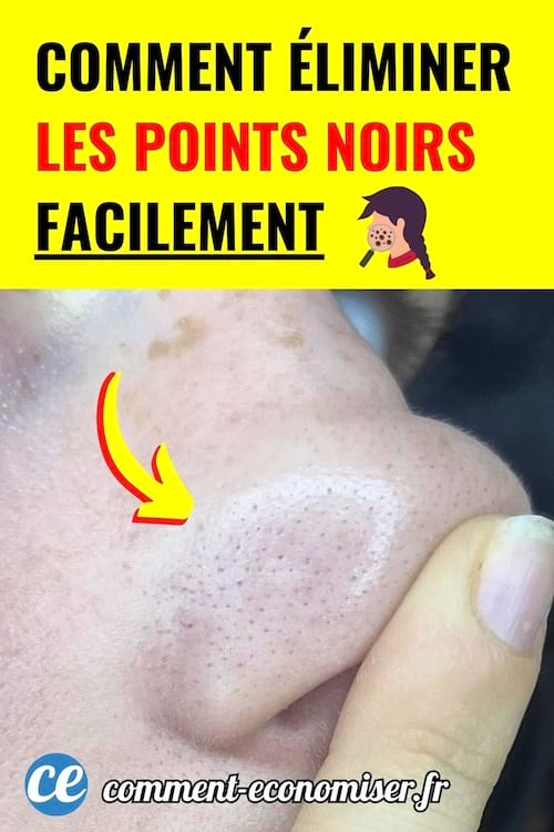 gros plan sur nez avec nombreux points noirs et pores visibles