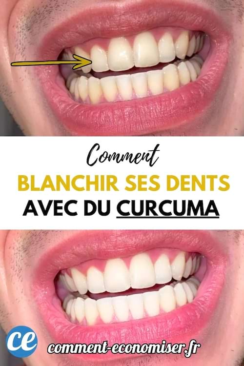 Dents blanche gr&acirc;ce au curcuma