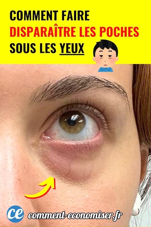 gros plan sur oeil avec poche marquee et cernes visibles dessous