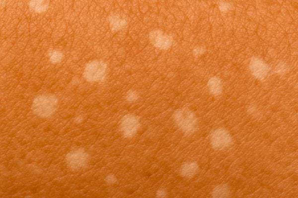 Zoom sur une peau bronzee avec petits points blancs