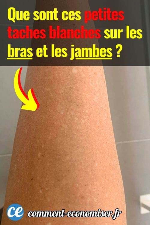 Gros plan d&rsquo;un bras montrant de petites taches blanches visibles sur la peau, mises en &eacute;vidence par une fl&egrave;che