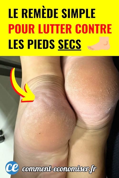 gros plan sur talons secs et legerement fissures avec peau rugueuse