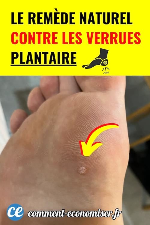 Ce remede naturel aide a eliminer les verrues plantaires simplement.