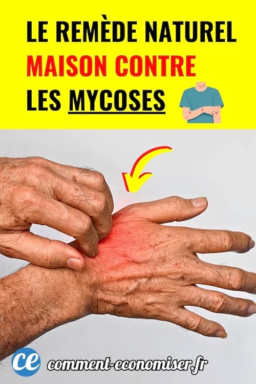 Une main gratte une irritation rouge sur la peau pour illustrer un remede naturel contre les mycoses.