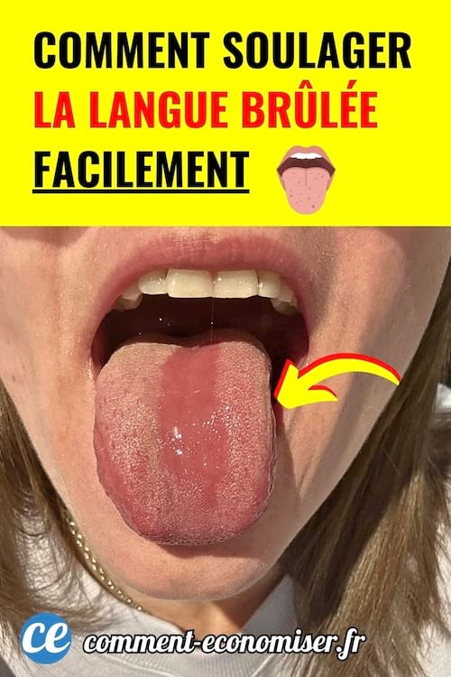 Gros plan sur une bouche avec la langue sortie pour montrer une astuce pour soulager une langue brulee.