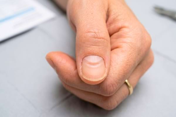 un ongle pr&eacute;sentant une ligne de Beau (un creux horizontal bien visible)