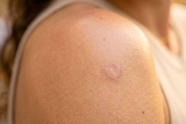 l&eacute;g&egrave;re cicatrice ronde et claire sur une &eacute;paule