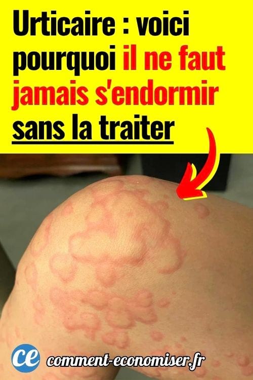 Peau pr&eacute;sentant des plaques rouges d&rsquo;urticaire sur une &eacute;paule avec irritation visible