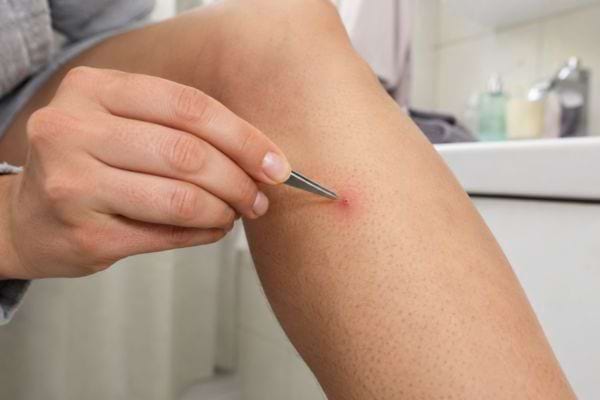 Main approchant une pince à épiler d’un poil incarné rouge sur la jambe.