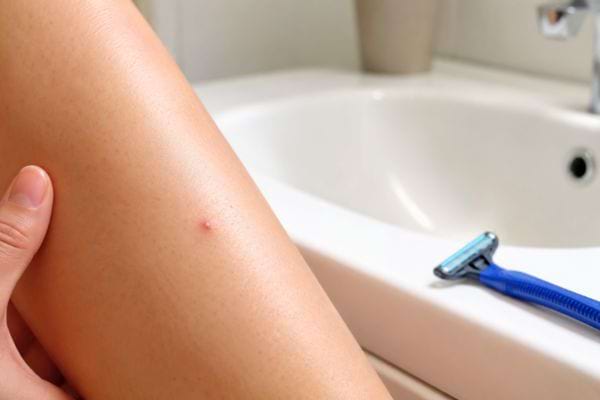 Petit bouton rouge de poil incarné après rasage sur la jambe.