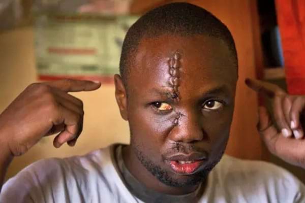 Un homme avec une large cicatrice au visage