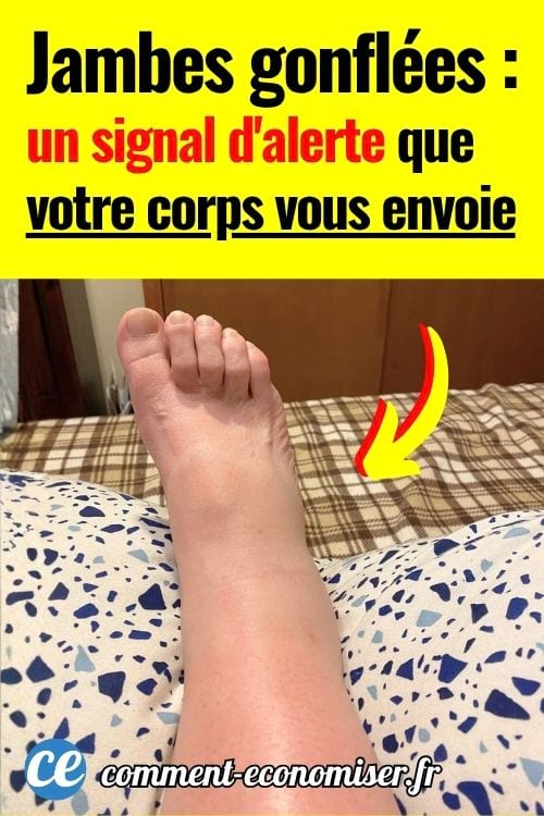 Pied et cheville gonfl&eacute;s reposant sur un lit, avec &oelig;d&egrave;me visible sur la jambe