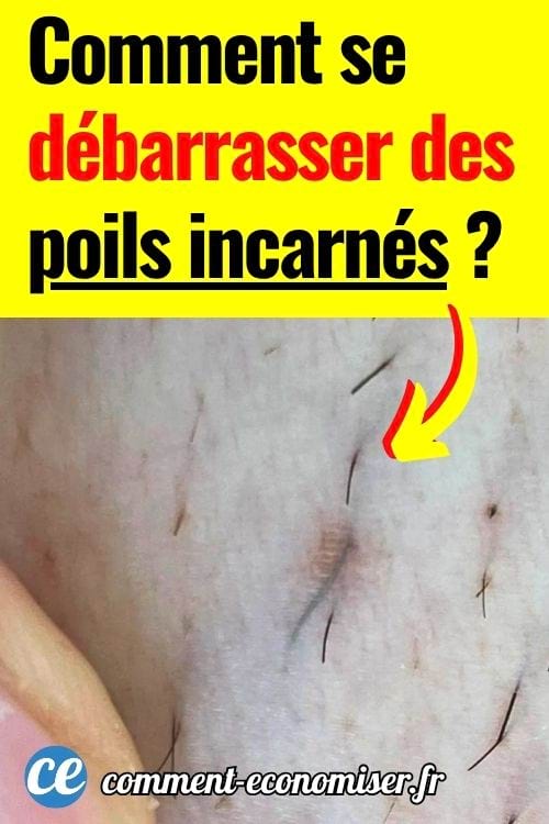 Poils incarnés visibles sur une peau rasée en gros plan.