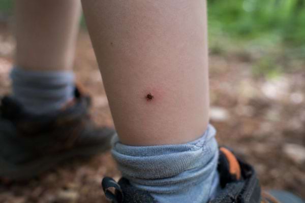 Tique &agrave; tache blanche accroch&eacute;e &agrave; la jambe d&rsquo;un enfant apr&egrave;s une promenade en for&ecirc;t