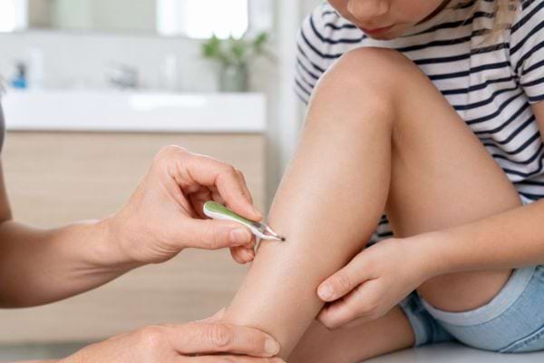 Retrait d&rsquo;une tique sur la jambe d&rsquo;un enfant avec une pince fine en toute s&eacute;curit&eacute;
