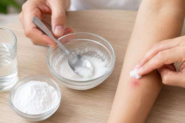 Application d’une pâte de bicarbonate sur une piqûre de moustique.