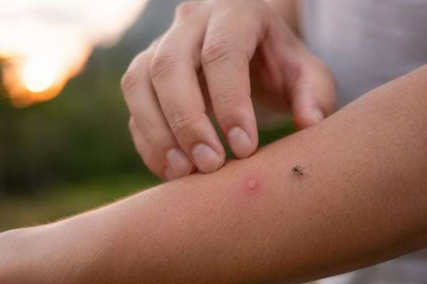 Piqûre de moustique rouge sur un bras avec une main prête à se gratter.