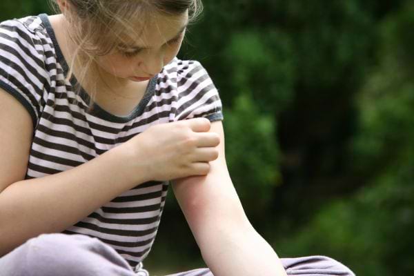 Bras d'une fille avec piqûre de moustique examiné avant d’appliquer du bicarbonate.