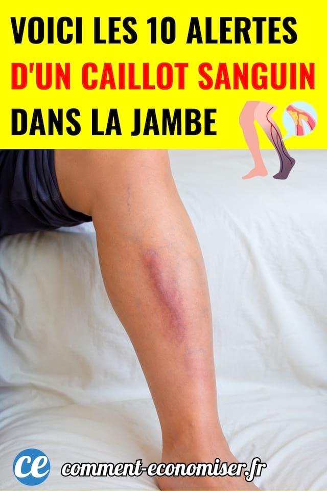 Une jambe avec une veine apparente