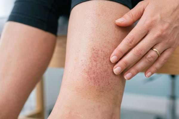 une zone de peau sur un mollet présentant une légère coloration rougeâtre