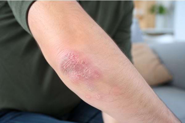 Plaque rouge et squameuse de psoriasis sur le coude d'un homme.