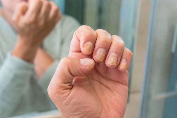 Ongles de la main épaissis et jaunis, signe de psoriasis unguéal.