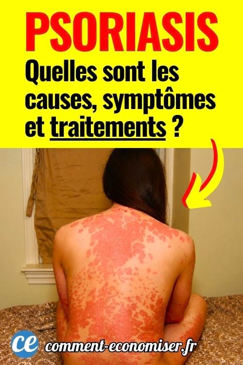 Dos couvert de plaques rouges évoquant une forte irritation de la peau