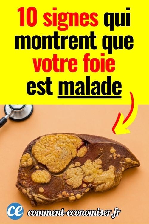 Foie malade avec amas graisseux et stéthoscope médical en arrière-plan