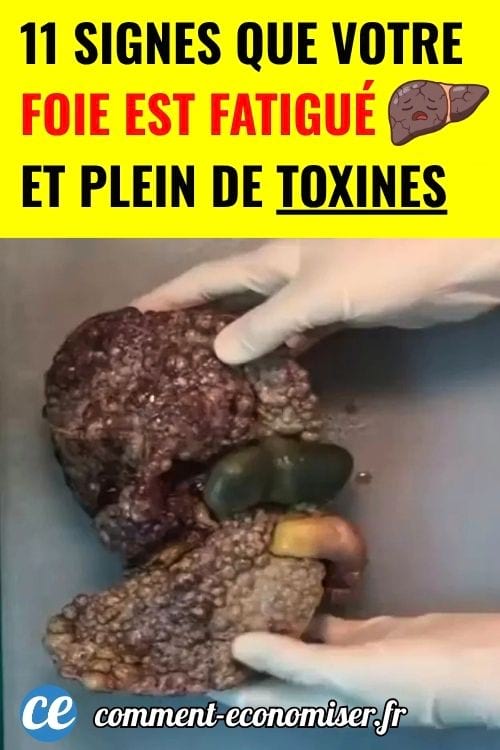 Foie malade tenu par des mains gantées pour illustrer les signes possibles d’un trouble hépatique.