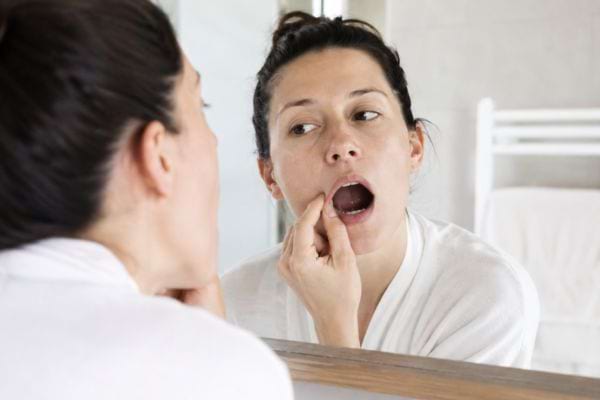Femme examinant sa bouche dans le miroir pour repérer les signes d’un muguet buccal.
