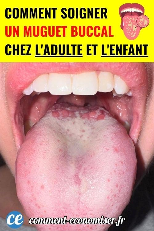 Bouche ouverte avec langue couverte de plaques blanches, signe d’un muguet buccal chez l’adulte.