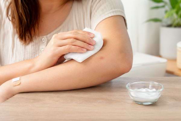 Femme appliquant une compresse froide près d’une piqûre de moustique.