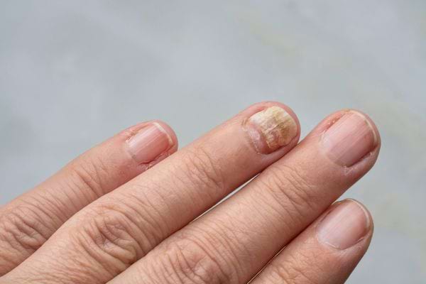 une mycose sur un ongle d'un doigt de la main