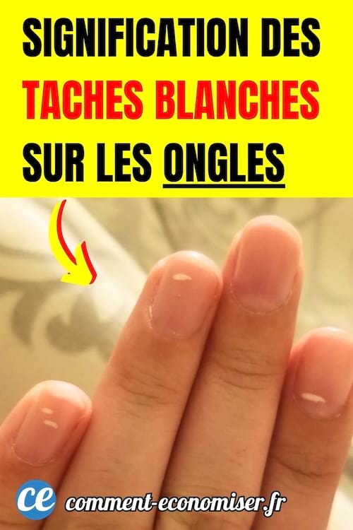 des ongles avec des taches blanches appelées leuconychie