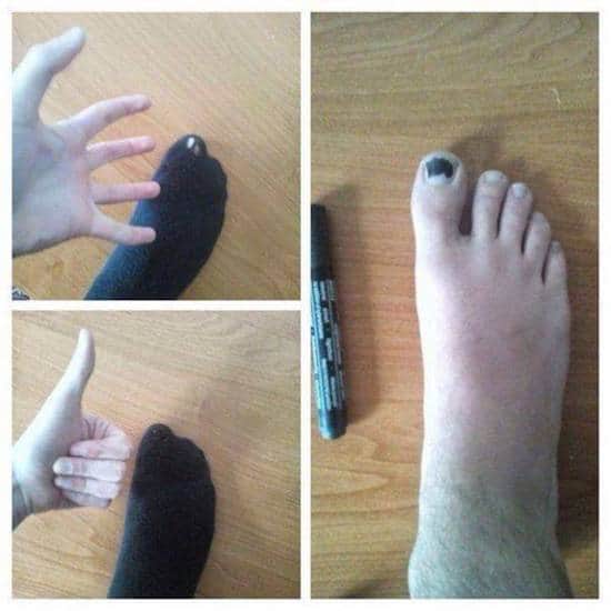 Écrivez sur l'ongle pour cacher un trou de chaussette