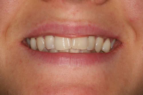 comment soulager mal de dent naturellement