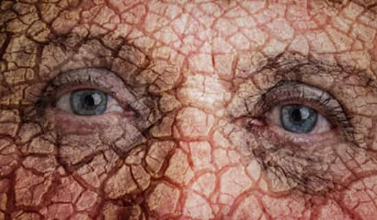 la peau sèche est un signe de deshydratation