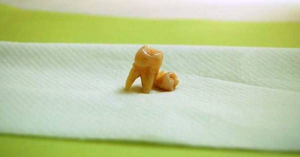 une molaire et une incisice sur un morcau de serviette en papier