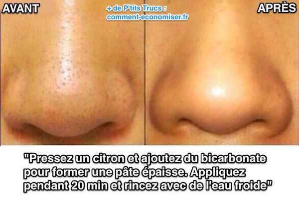 Remède qui marche contre les points noirs