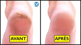 10 remedes pour soigner les crevasses aux talons